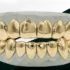 Custom Gold and Diamond Grillzz in Missouri